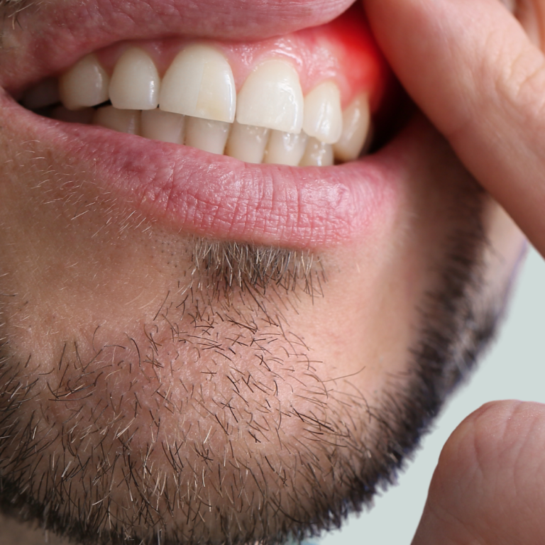 Diş Eti Hastalıkları ve Tedavisi